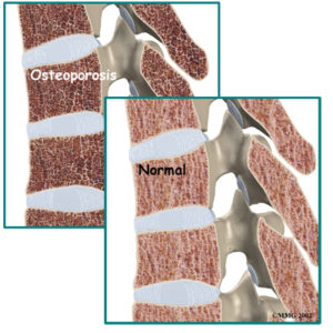 What happens to bones with osteoporosis?