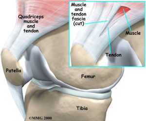 general_tendonitis_knee_anatomy05 (1) - Be In Motion Physiotherapy